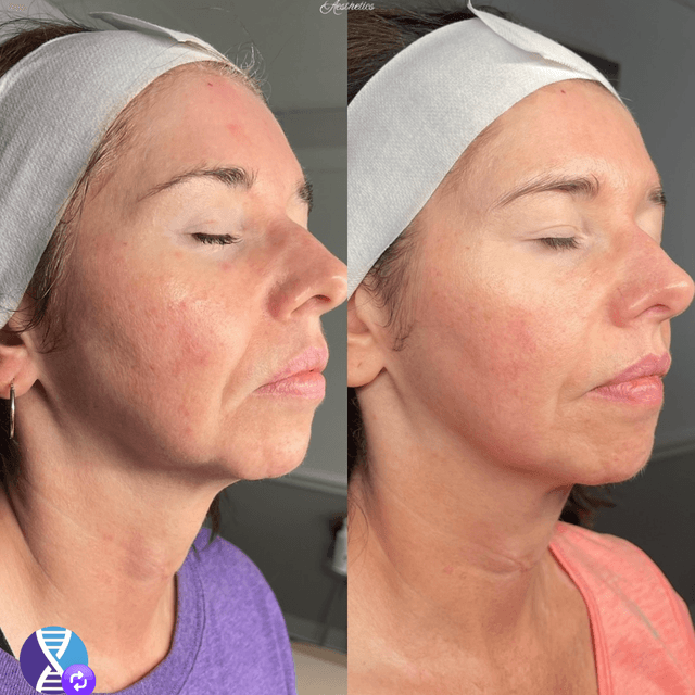 Microchanneling + Neck — 3 Sessions at Resilience Aesthetics in Knoxville, TN